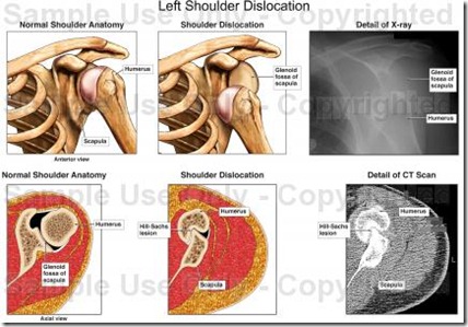 dislocated shoulder