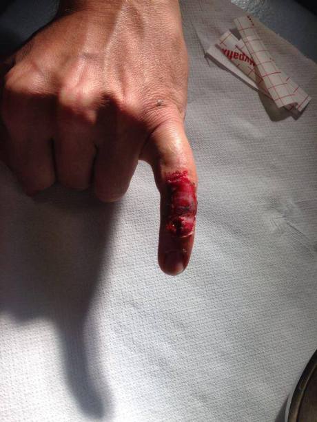 jari kelinking rossi terluka