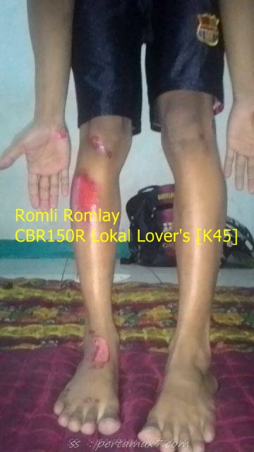 velg Honda CBR150R pecah hajar lubang kecelapatn tinggi kaki kegerus aspal 001