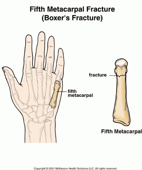marquez patah tulang telapak tangan kiri jelang motogp jepang 2015 pertamax7.com